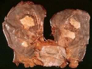 The white areas are pleural plaques in the lungs