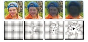 Typical progression of Macular Degeneration